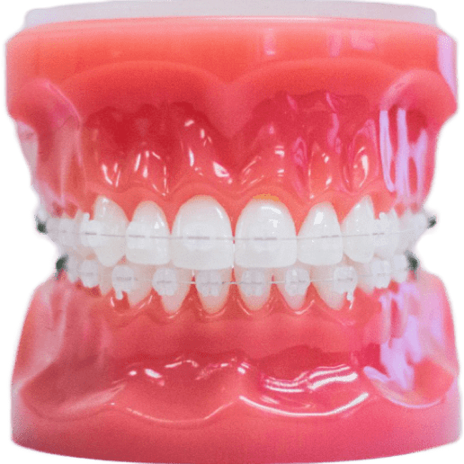 Clear ceramic braces treatment option at orthodontist in Irvine California
