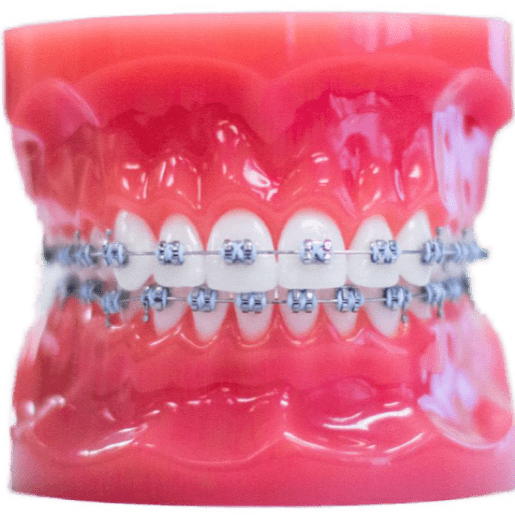 Metal braces orthodontic treatment model Irvine CA Orange County